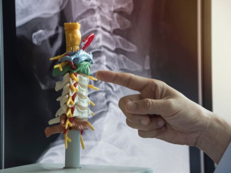 Minimally Invasive Spine Surgery in Delhi by Dr. Tarush Rustagi spine surgery Delhi