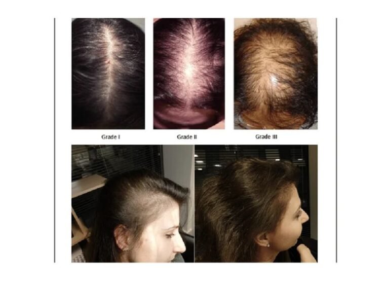 Effective Androgenic Hair Loss Treatment Services androgenic hair loss treatment