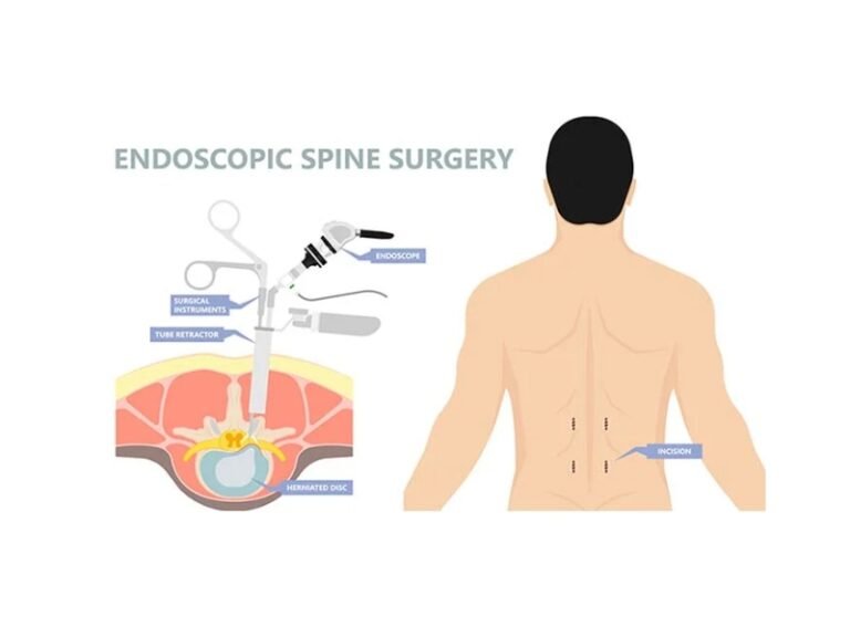 Minimally Invasive Spine Surgery in Delhi | Expert Care Minimally Invasive Spine Surgery Delhi