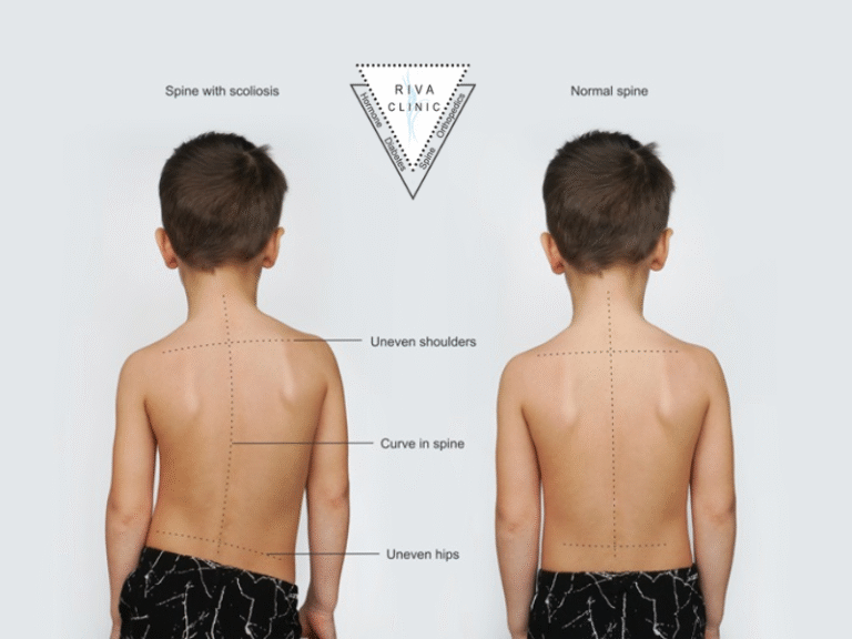 Scoliosis in children and teenagers